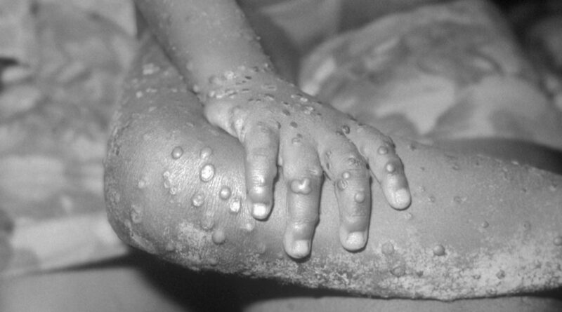 Nigeria: Monkeypox Is Endemic in Nigeria. but Surveillance Isn’t What It Should Be