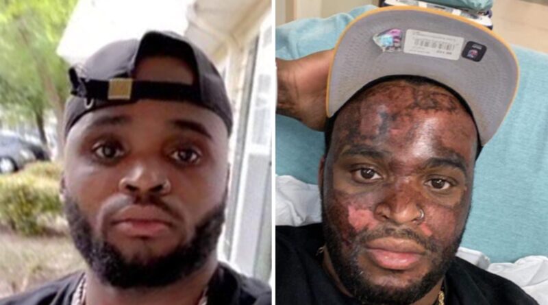 TikTok Chemical Peel Burn Man Awarded $1 Million In Damages for Burnt Face