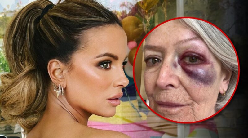 Kate Beckinsale Sparks Concern After Posting Photo of Mom with Bruised Eye