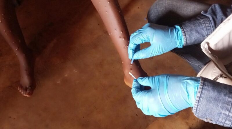 Zambia: Zimbabwe Reports First Two Mpox Cases, After Zambia Week Before