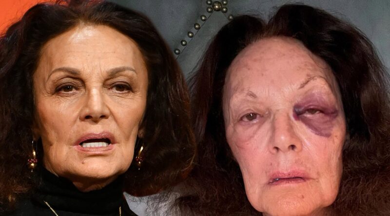 Designer Diane von Furstenberg Suffers Gnarly Black Eye After Fall