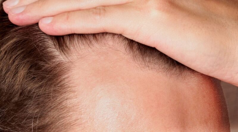 New Baldness Drug Boosted Hair Growth by 539% in Trials